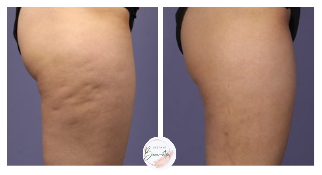 Résultat visible avant et après 9 séances de massage anti-cellulite Mix Magic à Chauray