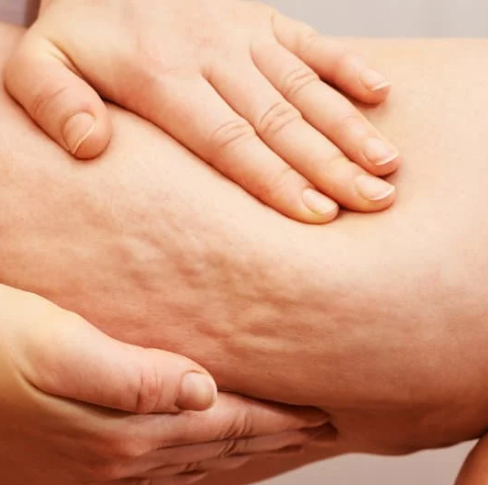 Aspect de la cellulite sur la cuisse d'une femme, avant un massage drainant